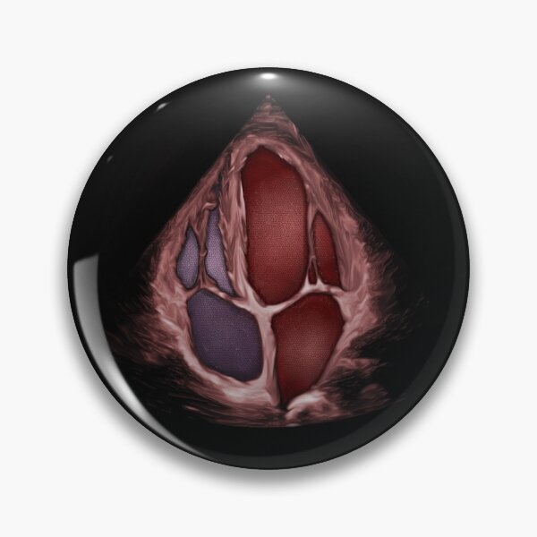 Item preview, 3D Apical 4 Chamber with blood effect designed and sold by EchoArtUK.