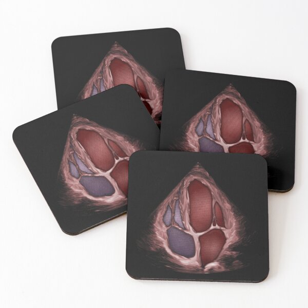 Item preview, 3D Apical 4 Chamber with blood effect designed and sold by EchoArtUK.