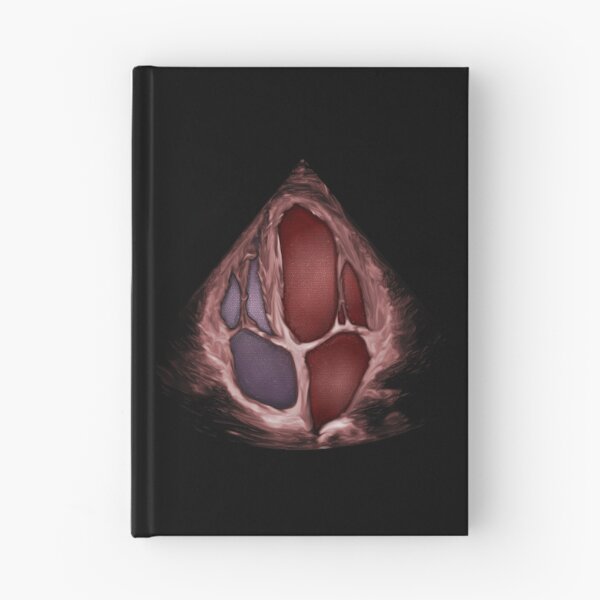 Item preview, 3D Apical 4 Chamber with blood effect designed and sold by EchoArtUK.