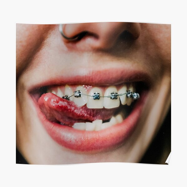 Premium Photo  Braces with blue and yellow rubber bands closeup