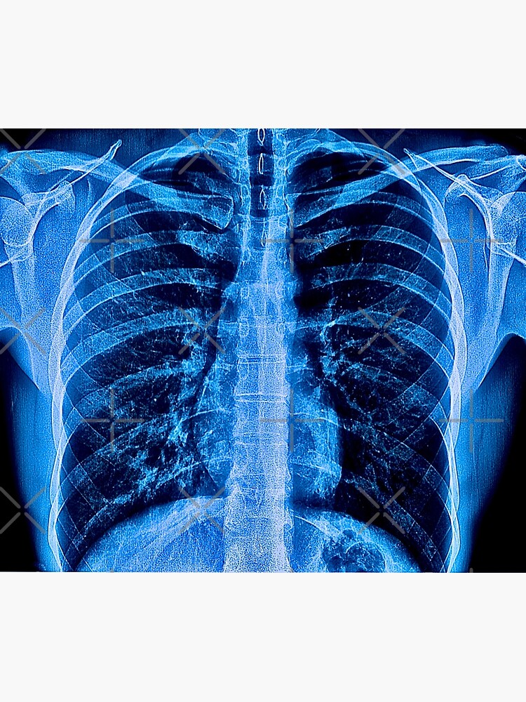 Chest X Ray Poster By Scottantonucci Redbubble