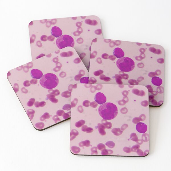 Item preview, BLAST CELLS BLOOD SMEAR MICROSCOPIC VIEW IMAGE MEDICAL LABORATORY SCIENTIST designed and sold by Hippiesole.