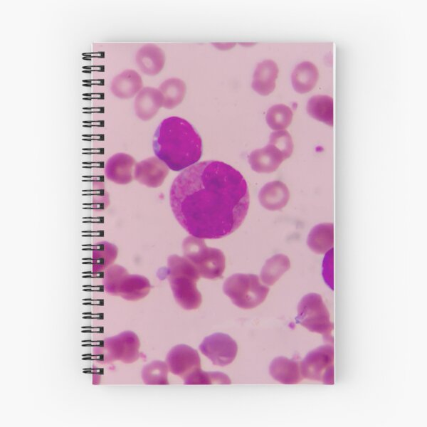 Item preview, BLAST CELLS BLOOD SMEAR MICROSCOPIC VIEW IMAGE MEDICAL LABORATORY SCIENTIST designed and sold by Hippiesole.