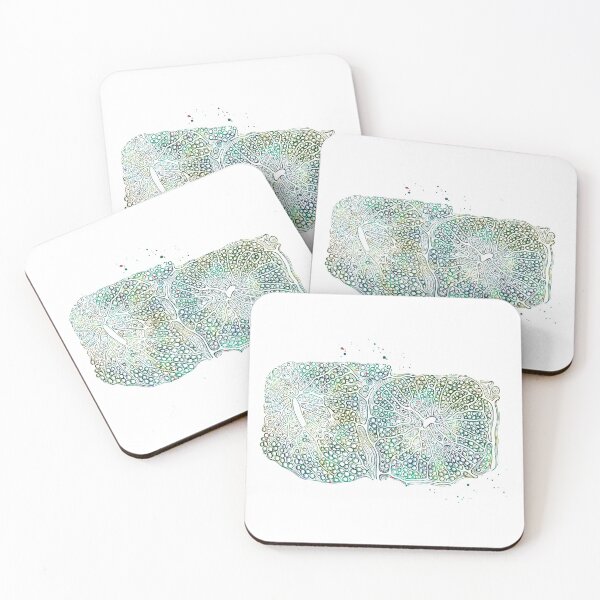 Item preview, Fatty infiltration of the Human Liver designed and sold by EvasDreams.