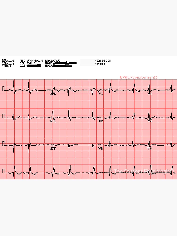 "Standard 12Lead ECG" Sticker for Sale by JohnnyCarotid Redbubble
