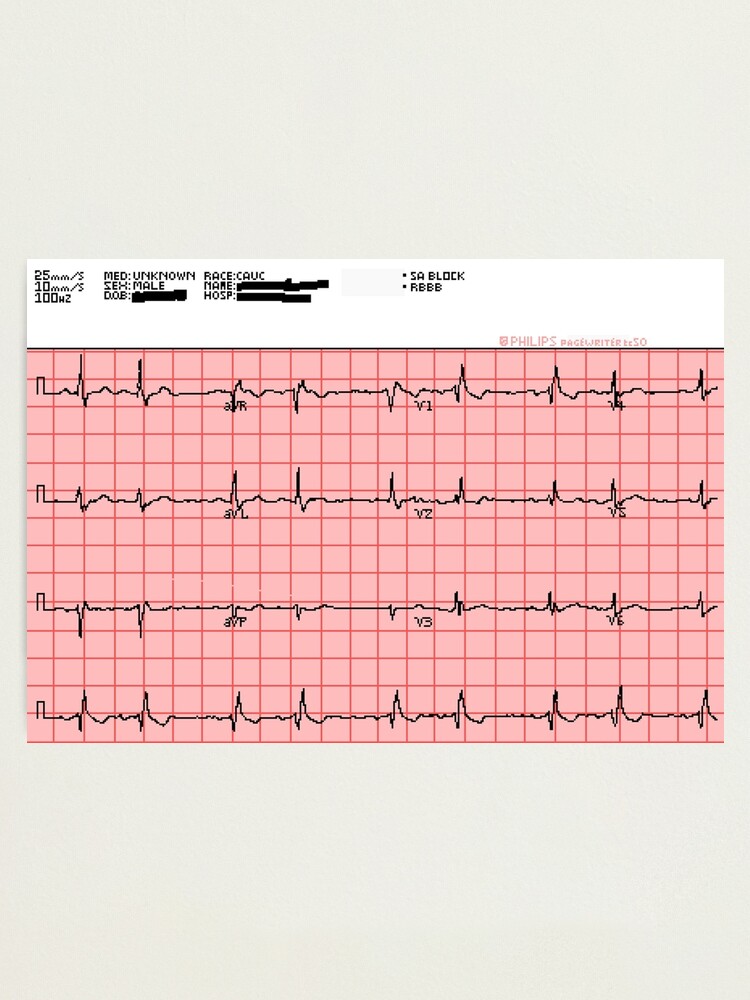 ECG anormal à 12 dérivations