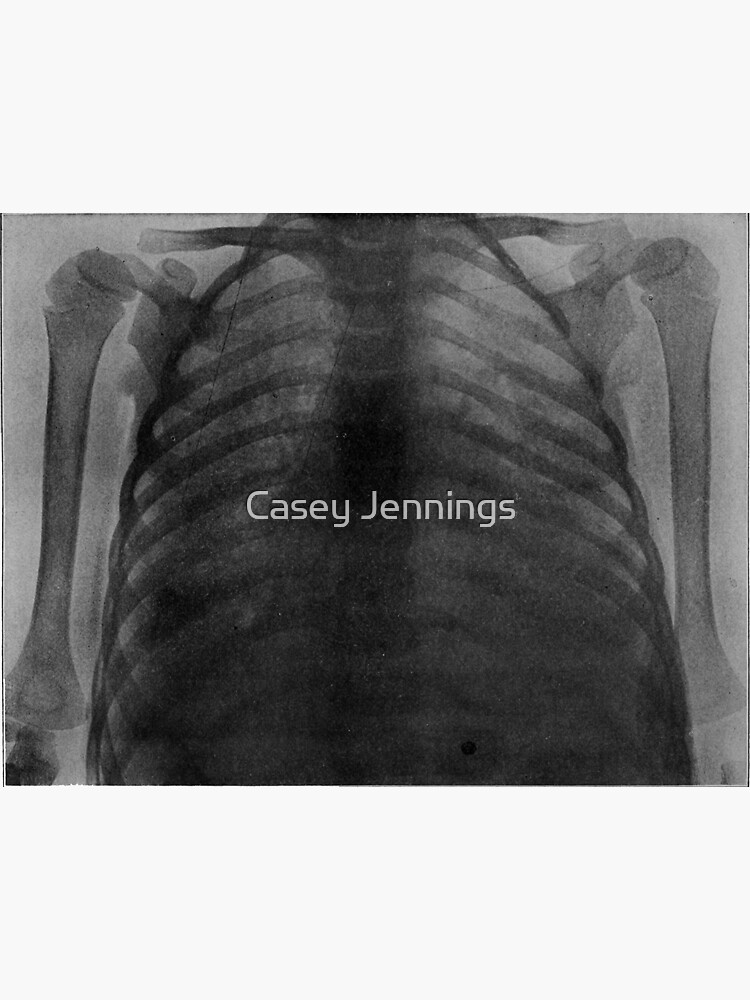 "Chest xray" Sticker by thegrimphantasm Redbubble