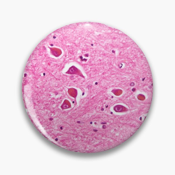 Item preview, Alzheimers Disease Histology designed and sold by deltoid.