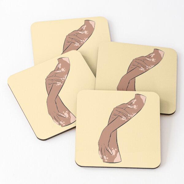 Item preview,  Vitiligo hand designed and sold by Popcorn Art.