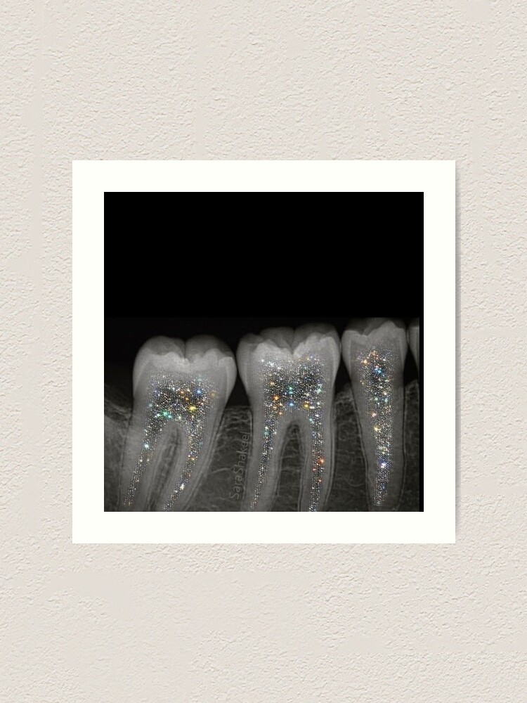"Dental xray with glitter" Art Print by guakamolly Redbubble