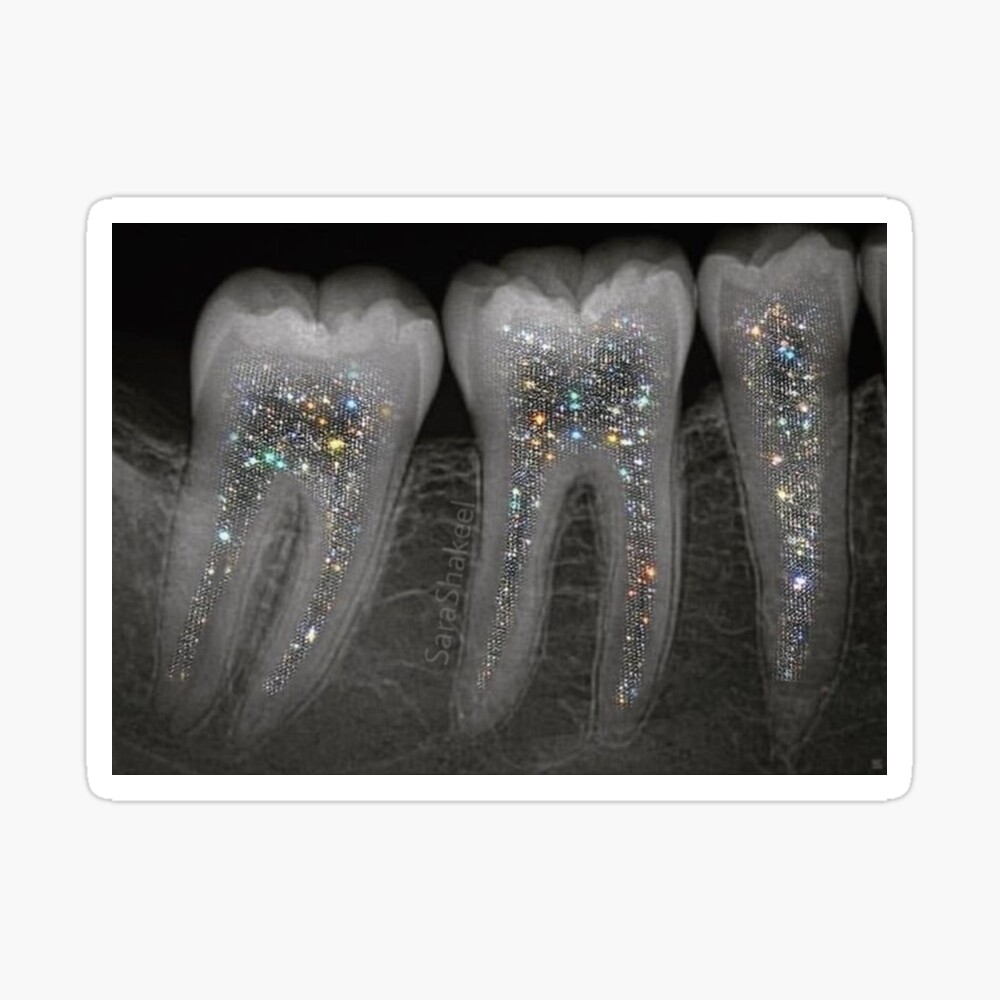 Dental x-ray with glitter