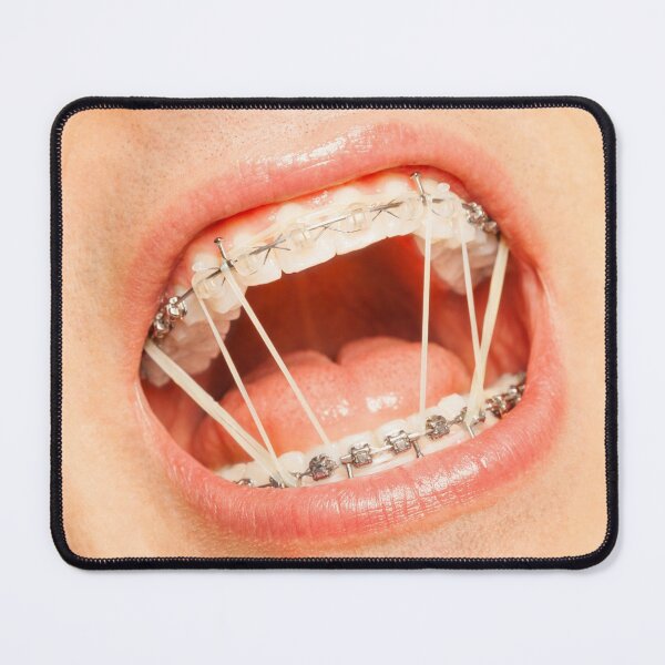 Item preview, Funny Open Mouth With Braces designed and sold by cgroenewald.
