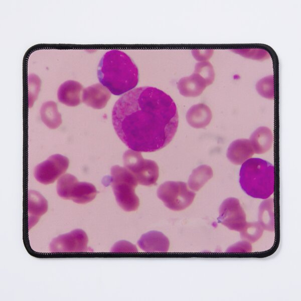 Item preview, BLAST CELLS BLOOD SMEAR MICROSCOPIC VIEW IMAGE MEDICAL LABORATORY SCIENTIST designed and sold by Hippiesole.