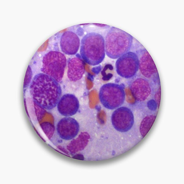 Item preview, Lymphoma designed and sold by Cytologyart.