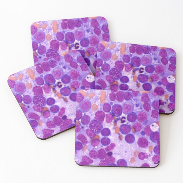 Item preview, Lymphoma designed and sold by Cytologyart.