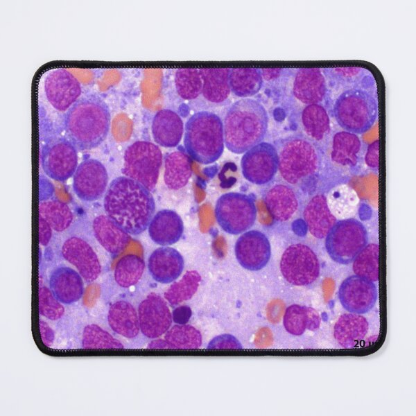 Item preview, Lymphoma designed and sold by Cytologyart.