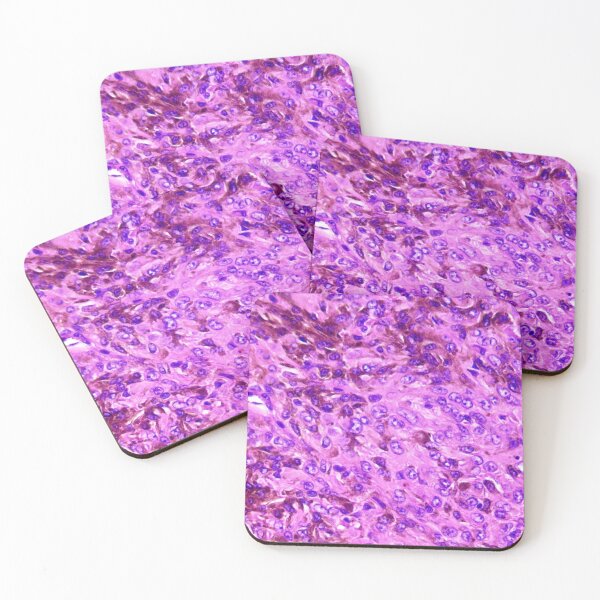 Item preview, Melanoma histology designed and sold by Cytologyart.