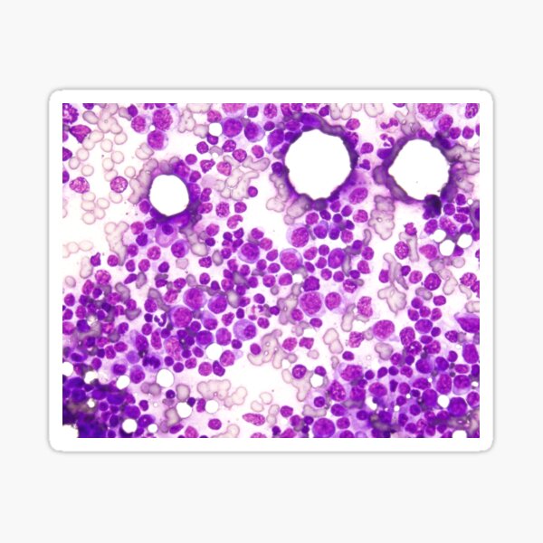 Item preview, Hyperplasia node (reactive) 4 designed and sold by Cytologyart.
