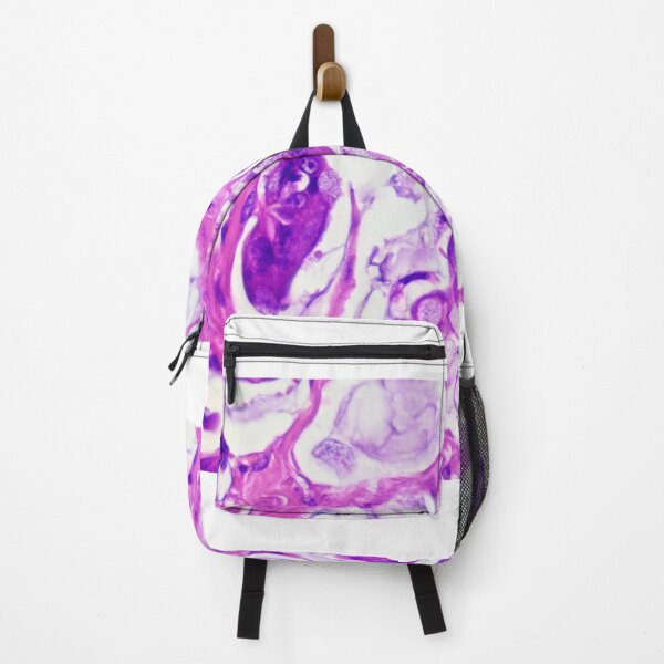 Item preview, Colon adenocarcinoma designed and sold by Cytologyart.
