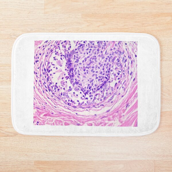 Item preview, Mural granulomatous folliculitis designed and sold by Cytologyart.