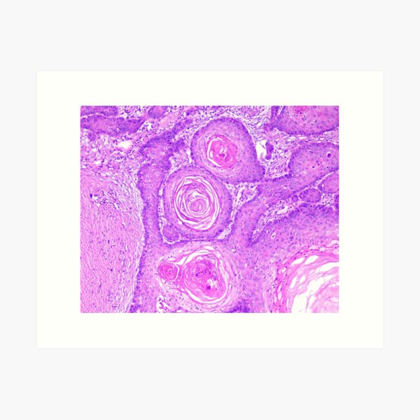 Aperçu de l'œuvre Perle de kératine carcinome épidermoïde créée et vendue par Cytologyart.