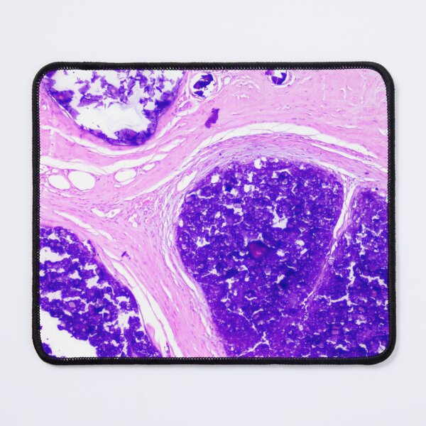 Item preview, Calcinosis cutis designed and sold by Cytologyart.
