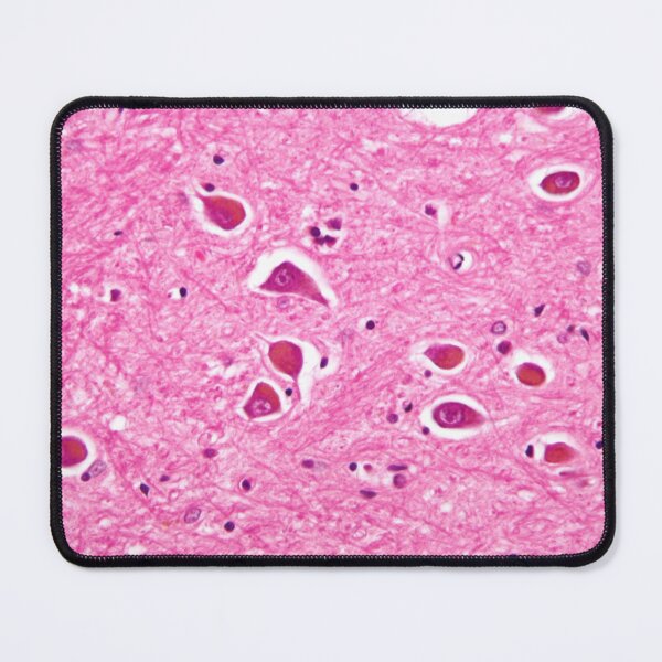 Item preview, Alzheimers Disease Histology designed and sold by deltoid.