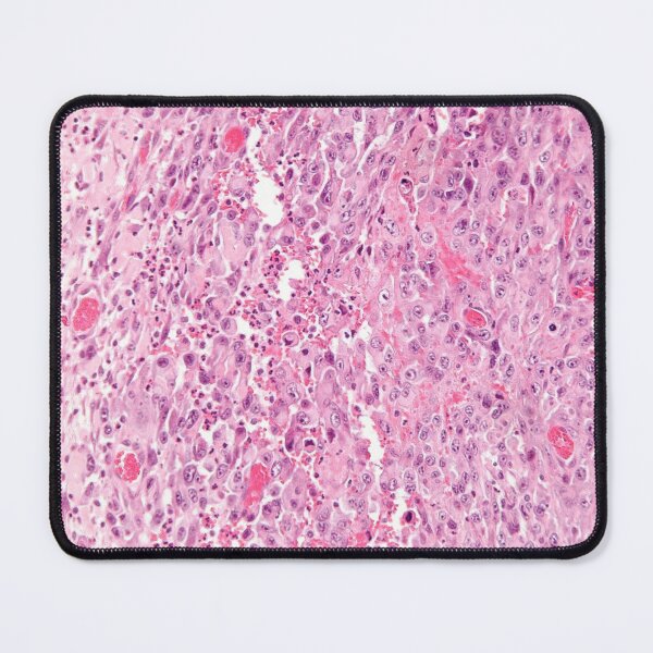 Item preview, Sarcoma Histology designed and sold by deltoid.