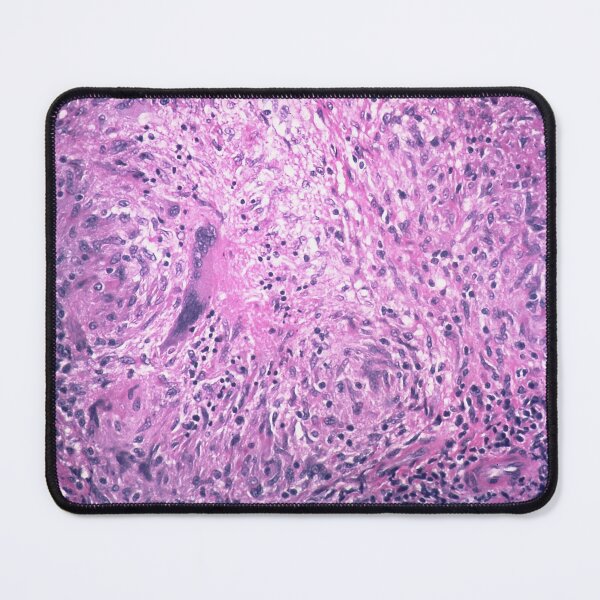 Item preview, Tuberculosis Histology designed and sold by deltoid.