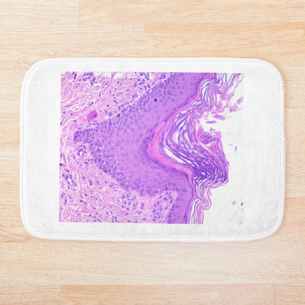 Item preview, acantose hipergranulose 200x designed and sold by Cytologyart.