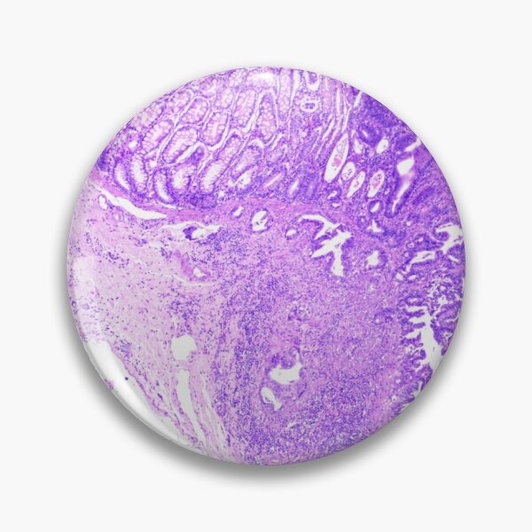 Item preview, colon adenocarcinoma feline designed and sold by Cytologyart.