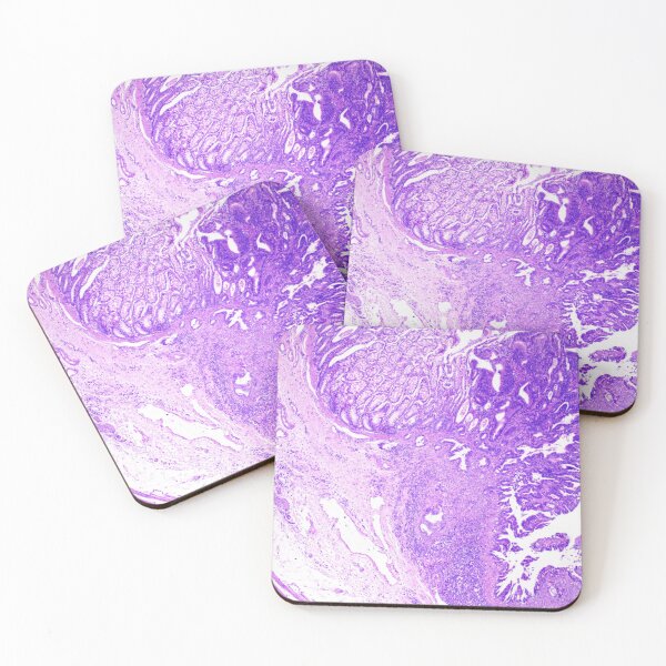 Item preview, colon adenocarcinoma feline designed and sold by Cytologyart.