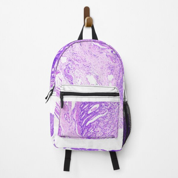Item preview, colon adenocarcinoma feline designed and sold by Cytologyart.