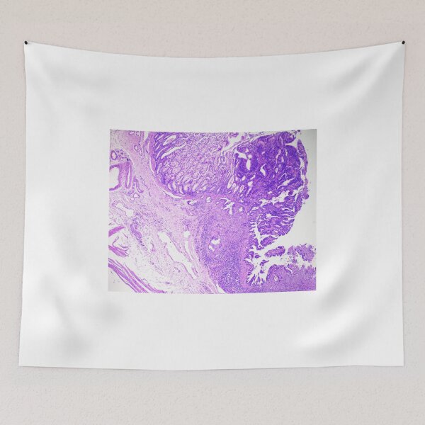 Item preview, colon adenocarcinoma feline designed and sold by Cytologyart.