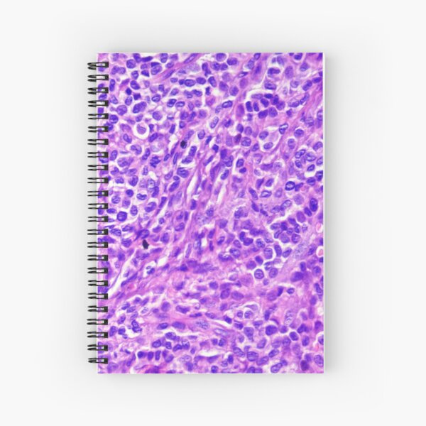 Item preview, Histiocytoma 2 designed and sold by Cytologyart.