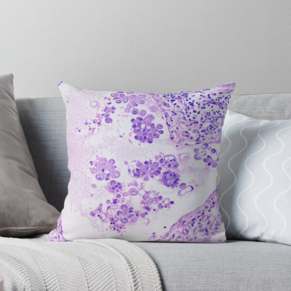 Item preview, mammary carcinoma 4 designed and sold by Cytologyart.