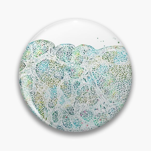 Item preview, Liver Histology Atrophic Cirrhosis Anatomy designed and sold by EvasDreams.