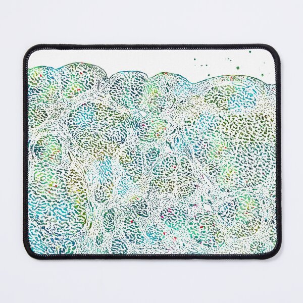 Item preview, Liver Histology Atrophic Cirrhosis Anatomy designed and sold by EvasDreams.