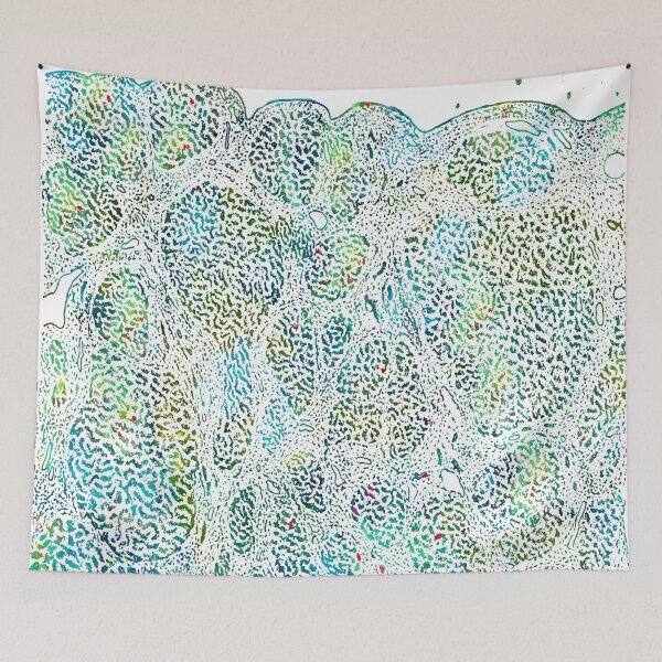 Item preview, Liver Histology Atrophic Cirrhosis Anatomy designed and sold by EvasDreams.
