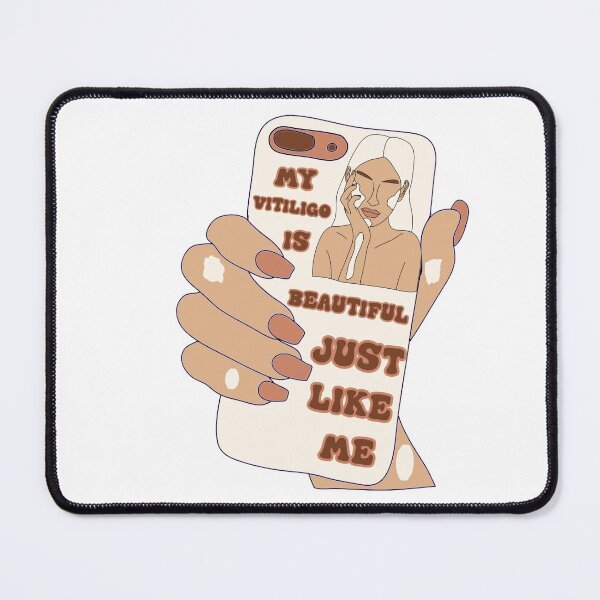 Item preview, MY VITILIGO IS BEAUTIFUL JUST LIKE ME PHONE designed and sold by DiscoVibes.