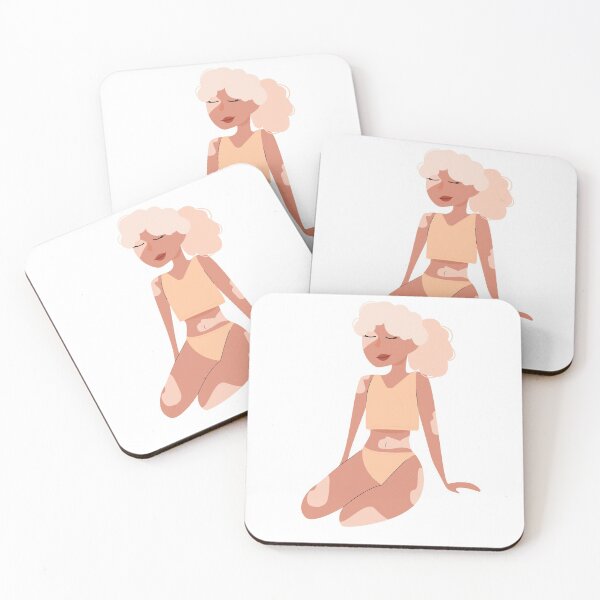 Item preview, Vitiligo.A girl with vitiligo is sitting. The concept of supporting people living with vitiligo and raising awareness of chronic skin disease. designed and sold by ProjectKittyArt.