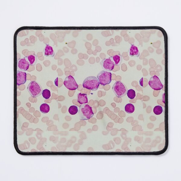 Item preview, Blast Cells and Anemia designed and sold by tasturm1.