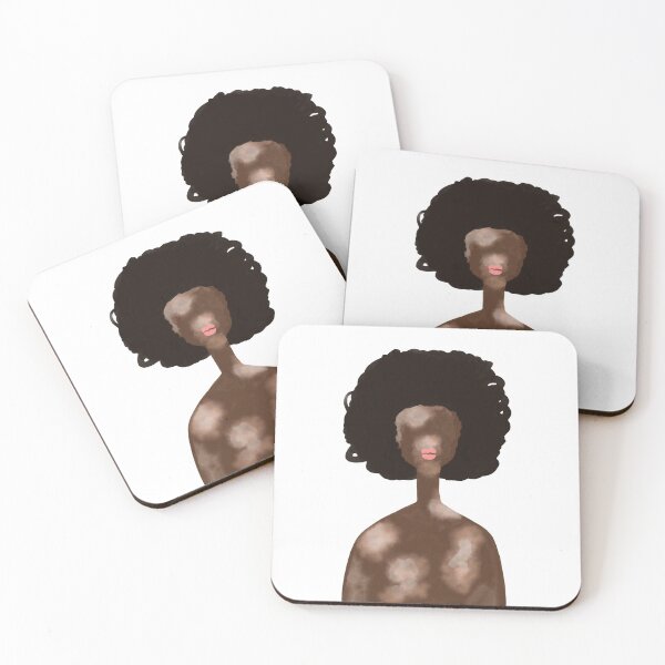 Item preview, Vitiligo woman portrait designed and sold by SolArt88.