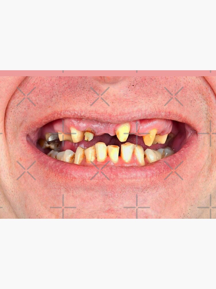 "Bad Teeth Meth Mouth Funny Smile" Mask for Sale by BetterDaze Redbubble