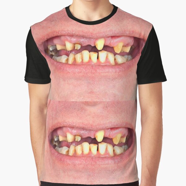 Item preview, Bad Teeth Meth Mouth Funny Smile designed and sold by BetterDaze.