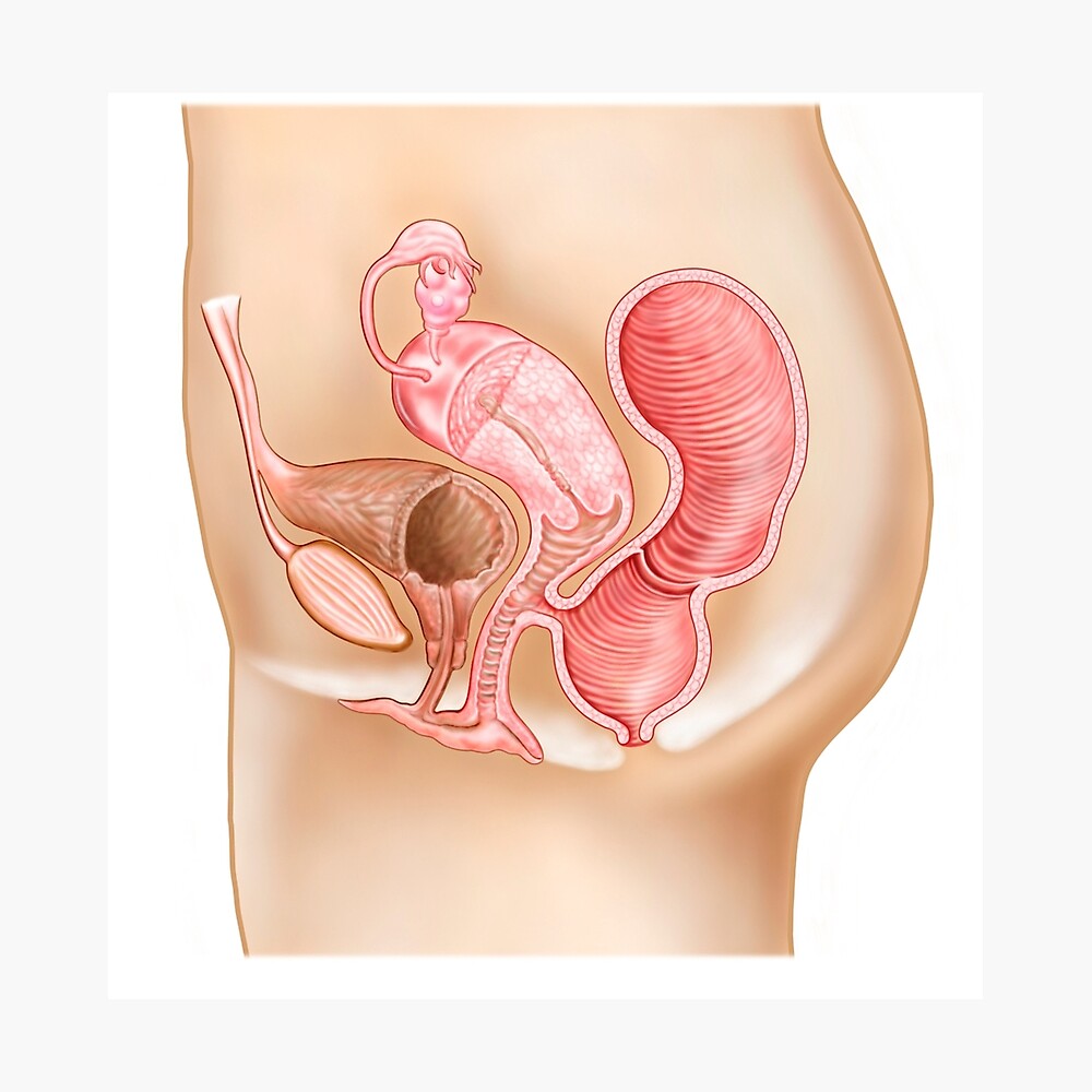 Rectovaginal fistula and cross section of female reproductive organs.