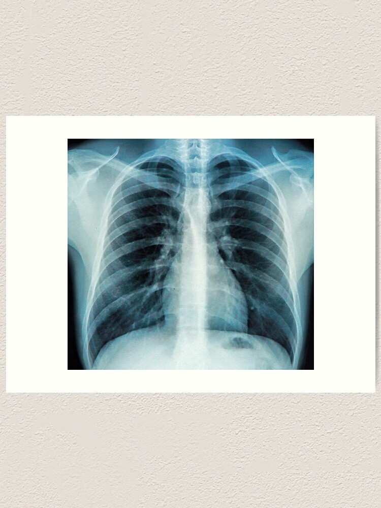 Three Quarter View Of Female Chest Muscles, X-ray Poster Print By