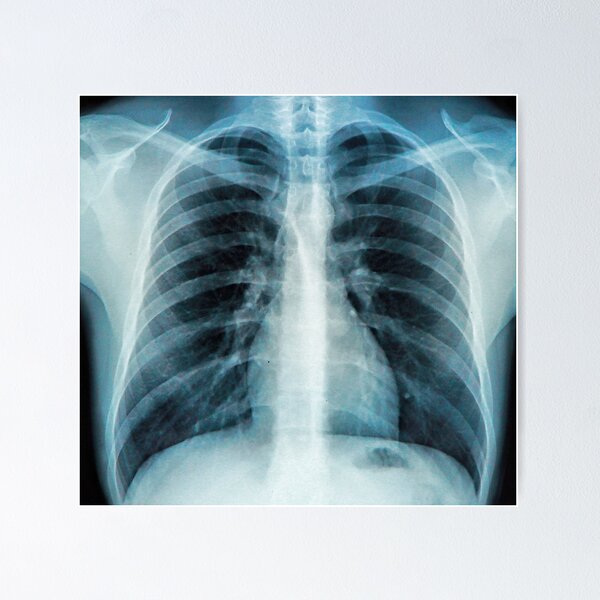 Item preview, Chest X Ray Picture designed and sold by ramazis.