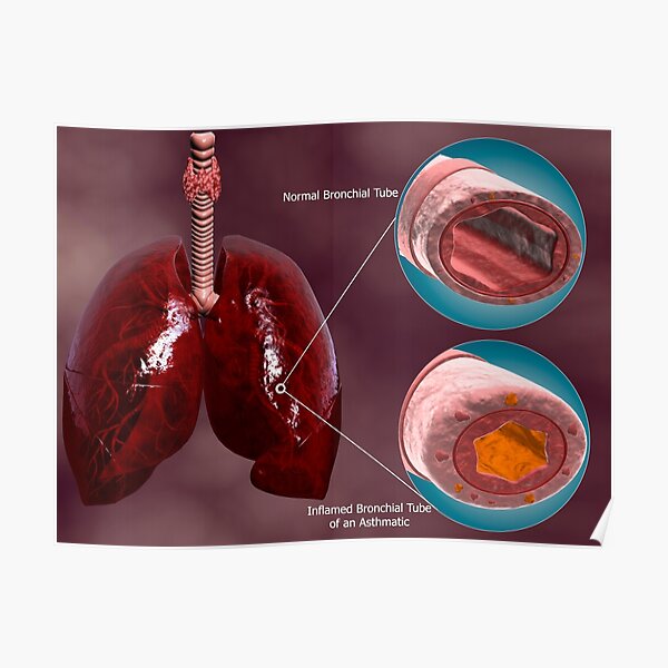 Trachea cross-section with lungs showing normal and asthmatic bronchiole. Poster