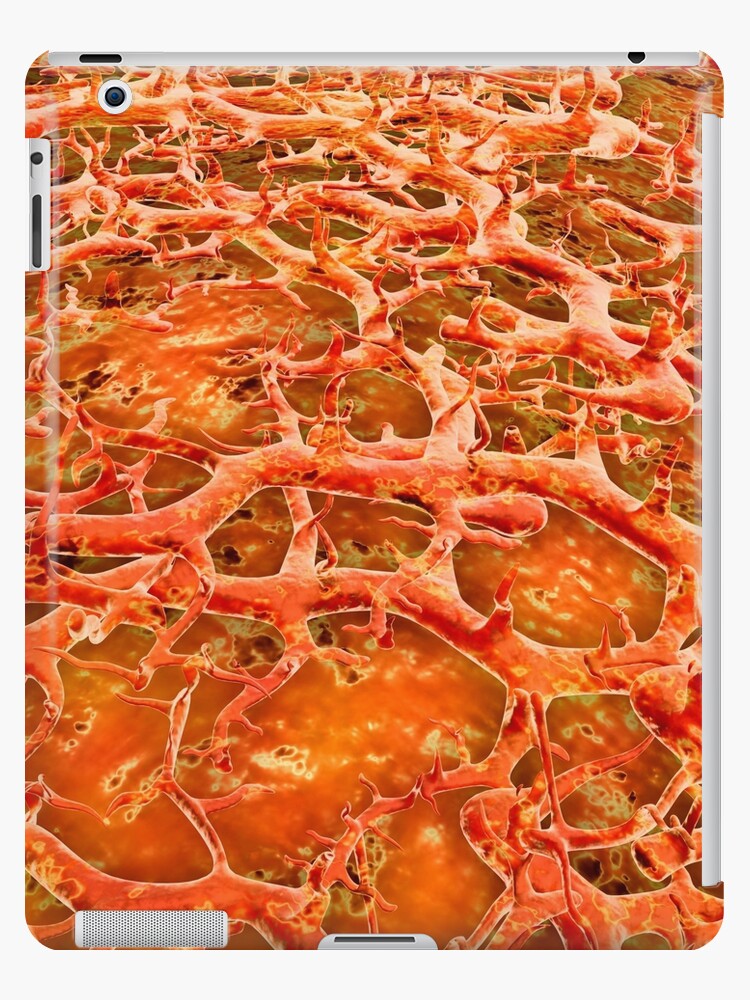 Close-up Of Athlete's Foot (tinea Pedis) Infection iPhone Case by